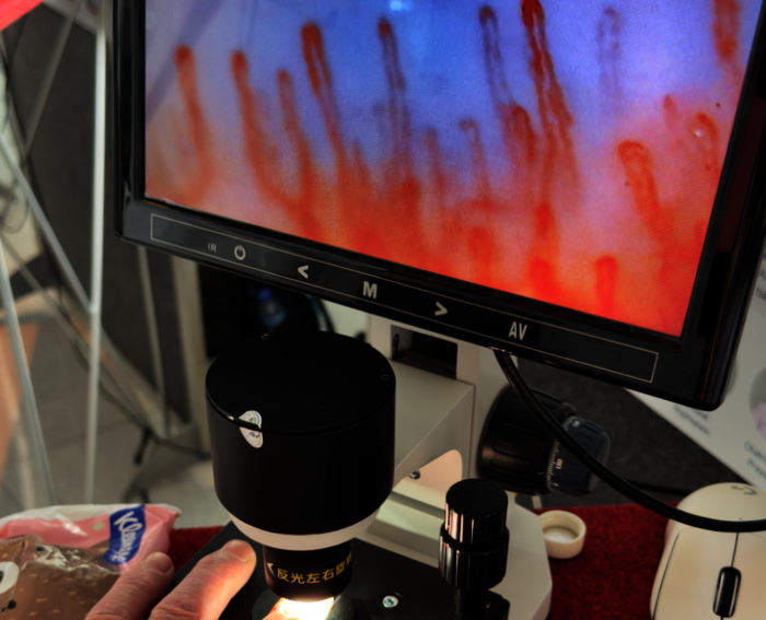 videocapillaroscopy