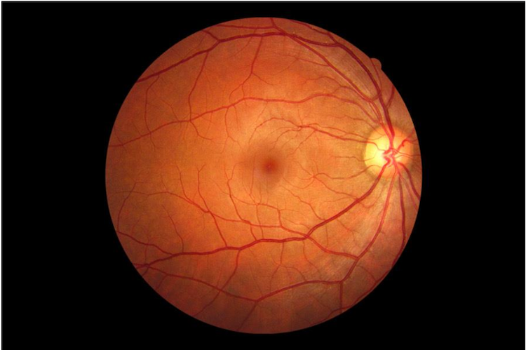 Damaged retina